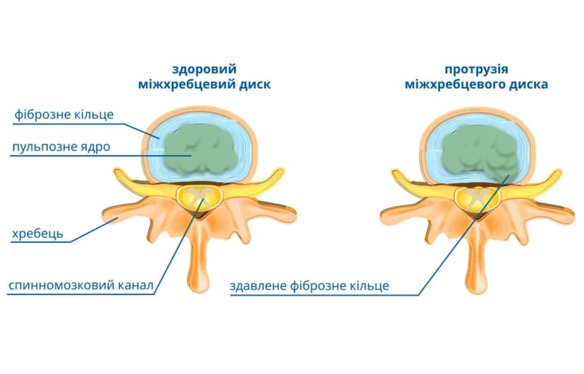 Будова міжхребцевого диска