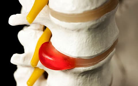 Хірургічні методи лікування гриж диска