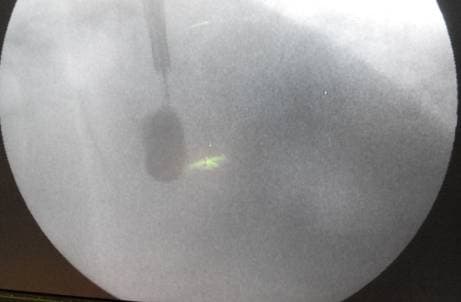 Баллоны в теле позвонка в раскрытом состоянии в боковой проекции