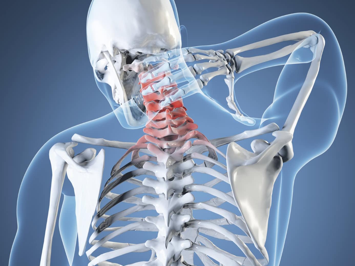 Протрузія шийного відділу хребта