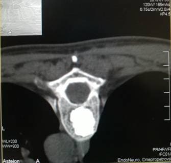 Состояние после вертебропластики