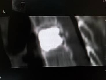 Цемент в теле позвонка