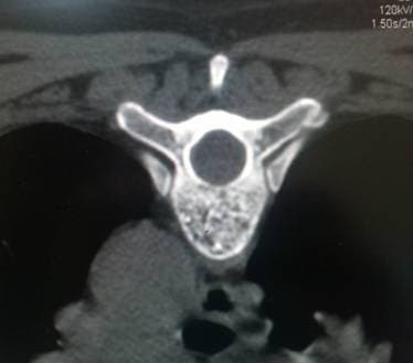Гемангиома тела позвонка (ячеистая структура)