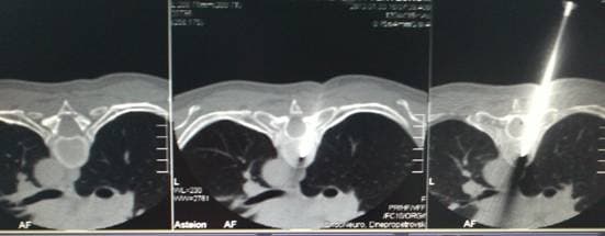 Игла в теле позвонка