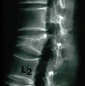 Состояние после введения цемента в позвонок
