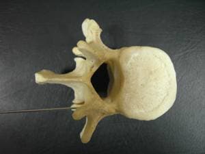 Боковой доступ для введения иглы