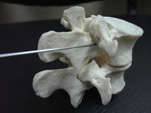 Боковой доступ для введения иглы