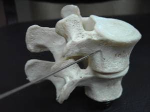 Доступ через корень дуги и суставного отростка